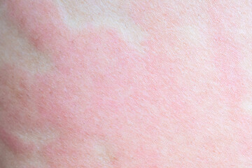 Fototapeta premium Skin allergy rash dermatitis texture close up