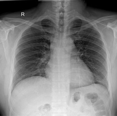 Human real digital x-Ray showing chest pa view 