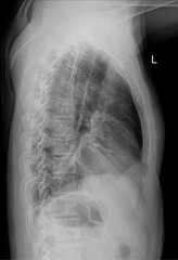 Human digital real radiograph showing chest lateral view 