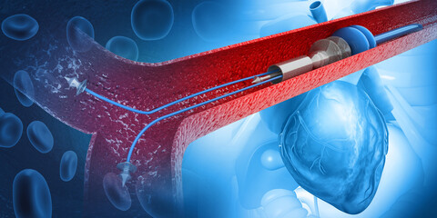 stent angioplasty procedure on medical background.3d illustration