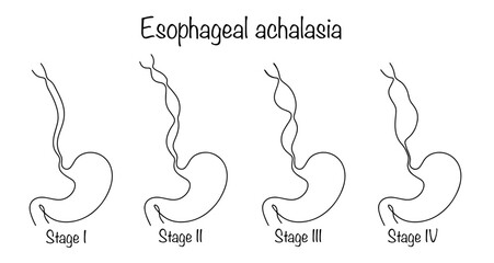 Esophageal achalasia