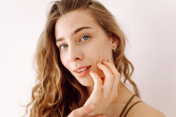Fototapeta premium Beautiful young girl with problem skin. Young woman with wavy hair gently touching her face. Dermatology, cosmetology, skin care. Natural skin.