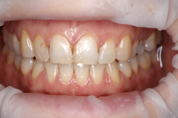 teeth with caries and old fillings