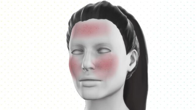 Redness on the face. Skin care. Cream. Medicine.