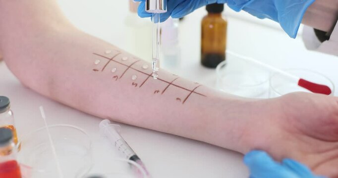 Allergy testing on the hand in a clinical setting with different solutions