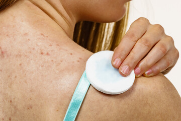 Woman acne on back cleaning skin with tonic