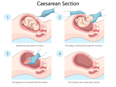 caesarean section procedure showing steps. incision, baby removal, placenta removal, suturing of incisions diagram hand drawn schematic vector illustration. Medical science educational illustration