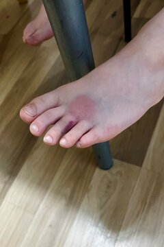 close up of a child's leg with a bruise and a fracture of the third toe. side view. bruise