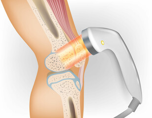 Laser therapy on a knee. Medical Laser Therapy Science