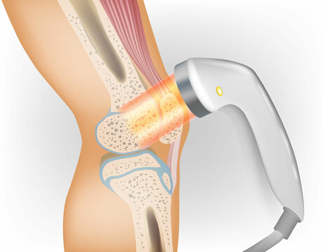 Laser therapy on a knee. Medical Laser Therapy Science