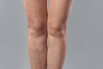 Woman with varicose veins on grey background, closeup