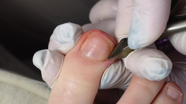 Podiatrist using pedicure clippers trims dry skin around a toenail