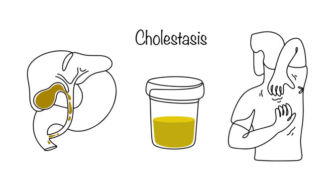 Cholestasis