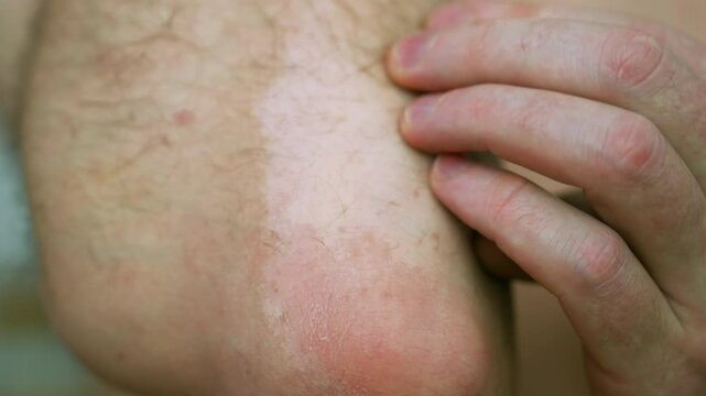 Vitiligo's Canvas: Male Elbow's Intricate Patterns | Skin's Monochrome Artistry Unveiled | Dermatological Diversity in Macro Detail | Visualizing Pigment Loss with Intimate Clarity