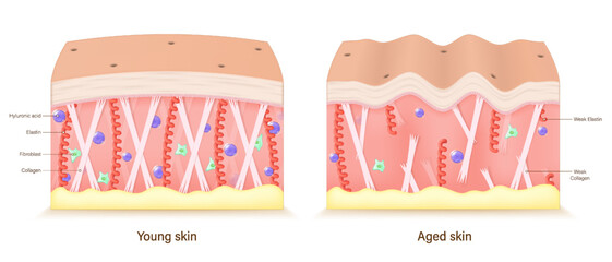 Aging skin. Comparison of young and aged skin. Facial skin problems. Hyaluronic acid, Collagen, Elastin and fibroblasts. Vector for advertising about beauty and medical treatment.