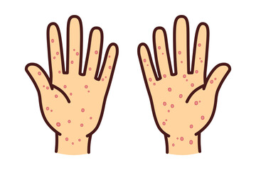 梅毒　皮膚病　手のイラスト素材