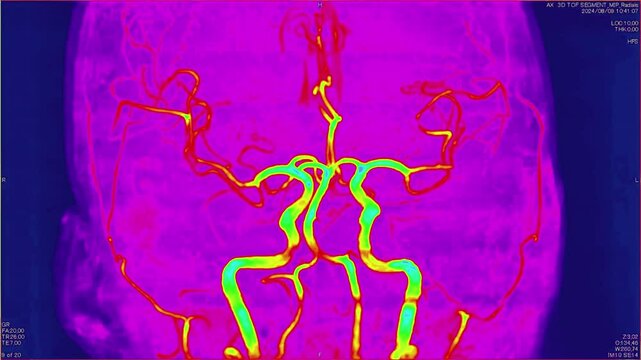 Magnetic resonance images of the brain, MRI of the brain, of a patient with multiple vascular infarctions, Contrast study of cerebral vessels, color animation Seamless Loop