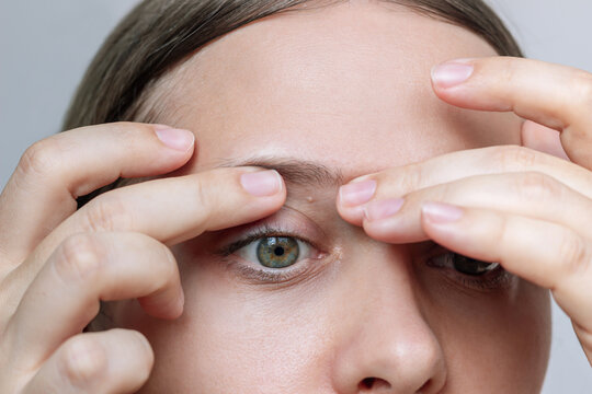 Milia (Milium) on the eyelid of a young woman. The girl showing white cysts on her skin with her hands on a grey background. Beauty and dermatology concept