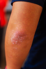 Fototapeta premium Detailed CloseUp Examination of a Skin Condition Present on an Individuals Arm