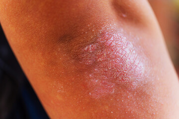 Naklejka premium Here is a close up image showcasing a persons elbow that has a rash on it