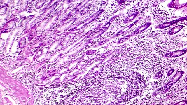 Light microscopy of a stomach tissue with intestinal metaplasia, displaying transformation of stomach lining cells into intestinal-like cells.