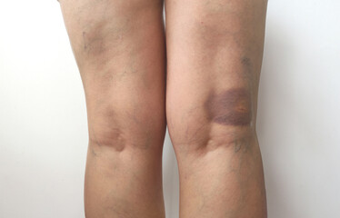 Close-up of a bruised kneecap with visible bruise and swelling. Bruises, hematomas on the human body. Healthcare and medicine, recovery from injuries