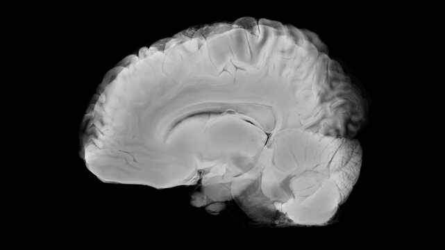 Sagittal Cross-Section of Human Brain with Ischemic Stroke on Transparent Background