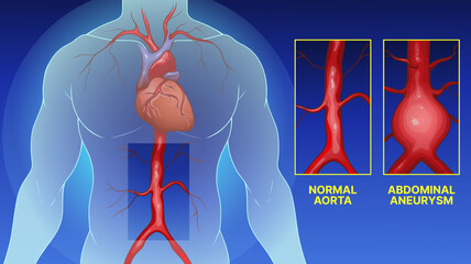 Abdominal aortic aneurysm (AAA). Normal aorta. Human body anatomy. Healthcare illustration. Vector illustration. 