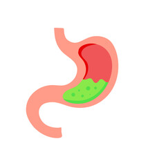 Acid reflux illustration 