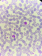 A smear of human blood under a microscope. Blood cells, red blood cells, white blood cells.