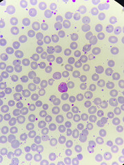 A smear of human blood under a microscope. Blood cells, red blood cells, white blood cells.