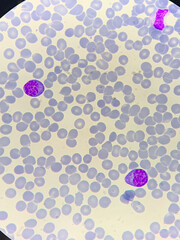 A smear of human blood under a microscope. Blood cells, red blood cells, white blood cells.