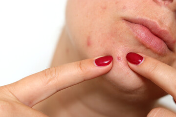 Close up of female face with red problematic acne skin and scars