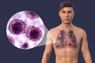 Naklejka premium Lung cancer, and close-up view of cancer cells, 3D illustration