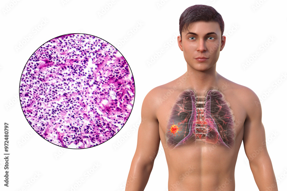 Sticker A man with lung cancer, 3D illustration and micrograph