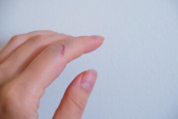 close-up of a finger with a small cut, showing the early stages of healing, highlighting the delicate nature of skin injuries and the need for proper care