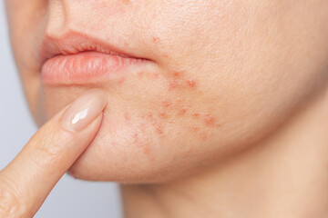 Close-up photo face of young Caucasian woman suffering from perioral dermatitis near the mouth....