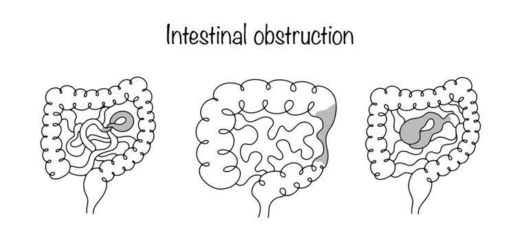Intestinal obstruction