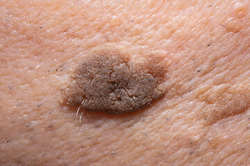Close-Up of Brown Seborrheic Keratosis (Seborrhoeic wart, Basal cell papilloma, Senile wart) Skin Growth on Cheek