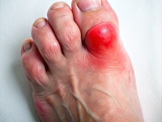 Close-up image of a swollen, red, and inflamed big toe joint on a foot, showcasing symptoms of gout,