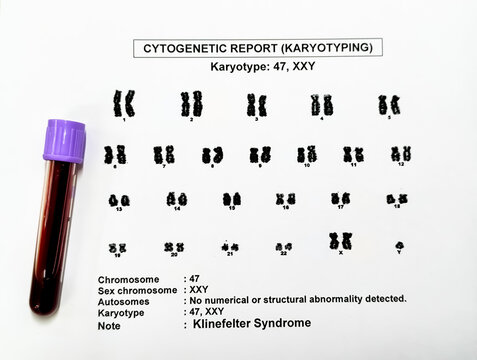 Klinefelter syndrome or KS with karyotyping report and blood sample, KS is a condition where the boys and men are born with an extra X chromosome. Klinefelter's, XXY