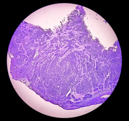 Photomicrograph of histological slide showing Neuroendocrine Cancer.