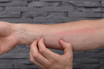 Podrażniona skóra na ręce przez intensywne drapanie po ukąszeniu owada © Paweł Kacperek