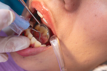 Closeup of an oral prophylaxis or dental cleaning procedure. A dental scaler is being used to remove plaque or tartar from the back of incisors, while a saliva ejector keeps the area dry.