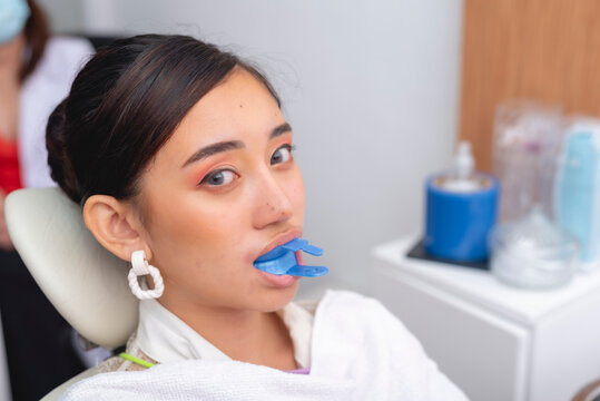 A female patient biting down on a blue fluoride gel foam tray in her mouth. Used for applying fluoride gel to strengthen teeth and prevent cavities during a dental treatment.