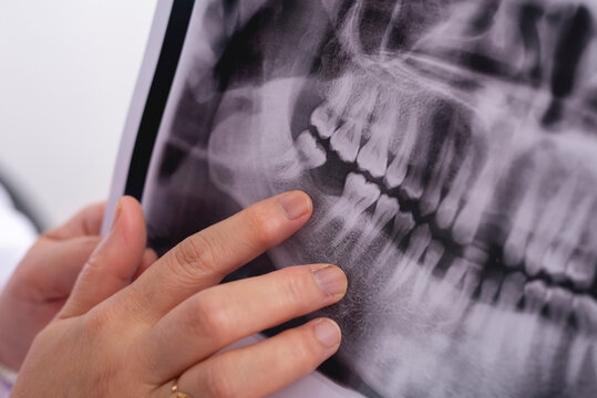 A close-up of a dental X-ray with a hand pointing to missing molar. The X-ray reveals details of the teeth and jaw, possibly highlighting an issue like impacted teeth or cavities