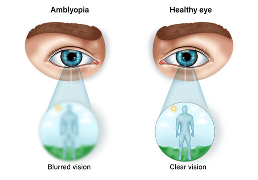 Comparative Analysis of Vision in Normal and Amblyopia Eye Conditions: A Detailed Science Vector Illustration for Educational Purposes