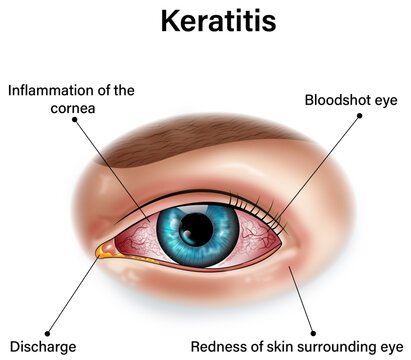 Keratitis Scientific Illustration, Corneal Inflammation with Labels Visualization
