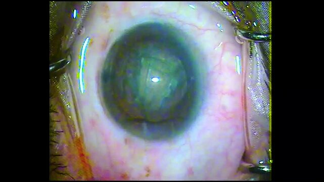Phacoemulsification Cataract Surgery Stages Shown in Sequential Panel