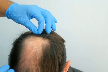 Doctor hands in gloves touching bald part of skin on man patient head. Preparing to hair transplant in clinic. Problem of baldness of men in middle age, treatment of alopecia by hair transplantation.